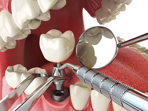 Best Chipped Tooth Repair Near Me  in Carleton, MI